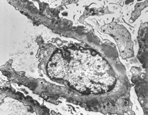 M,58y. | membranous glomerulopathy -early stage M,58y. | membranous glomerulopathy -early stage